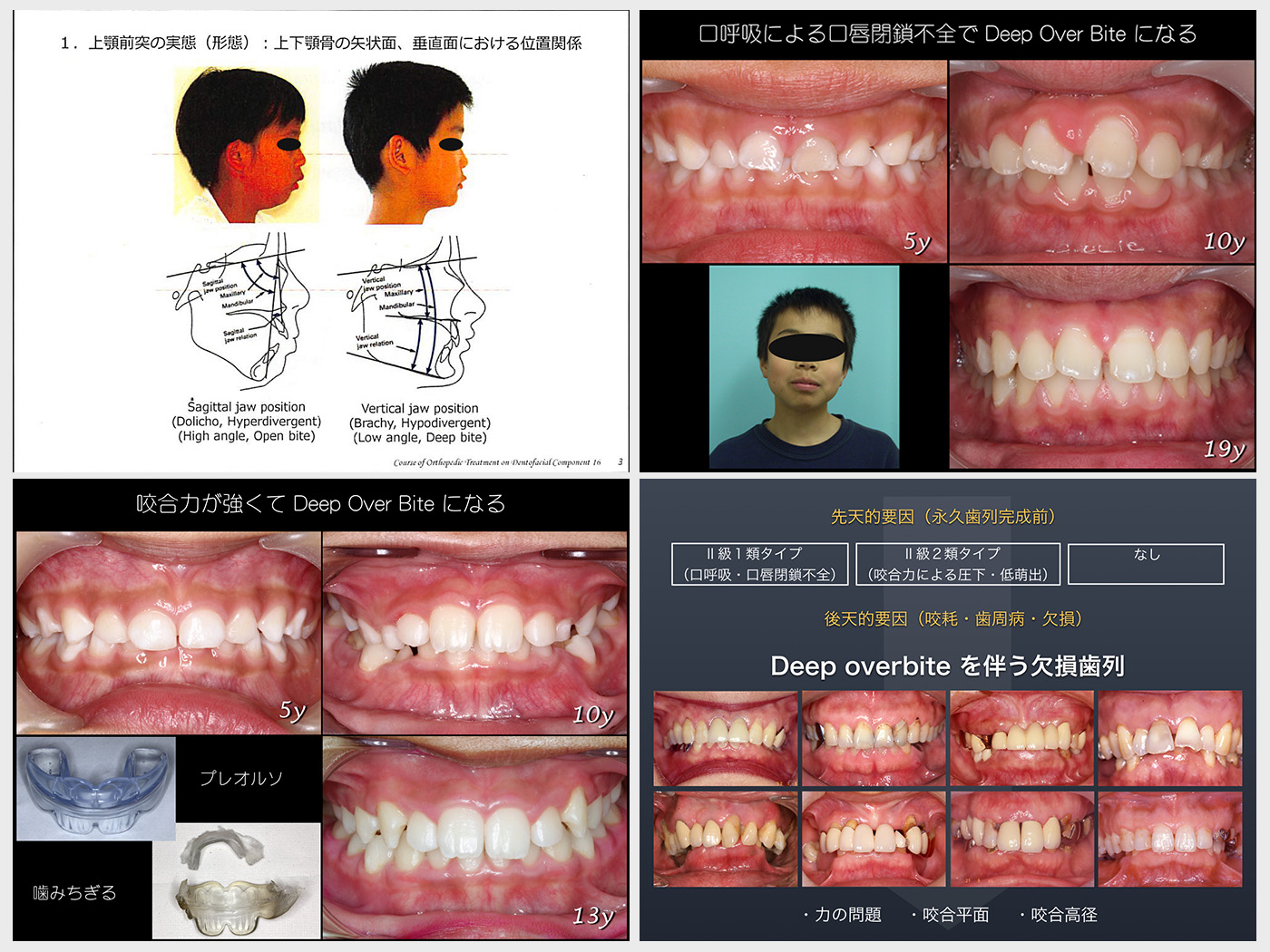 3 Deep Overbite の成り立ち 中舘歯科診療所のブログ あとみよそわか 3 Deep Overbite の成り立ち 中舘歯科診療所のブログ あとみよそわか