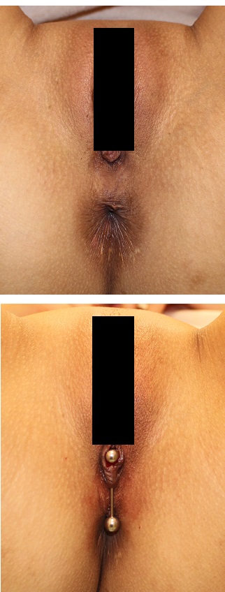医療機関でのピアス　　：　女性外性器　ピアス　　；　Fourchette piercing : フォルシェ・ピアッシング_d0092965_4305537.jpg