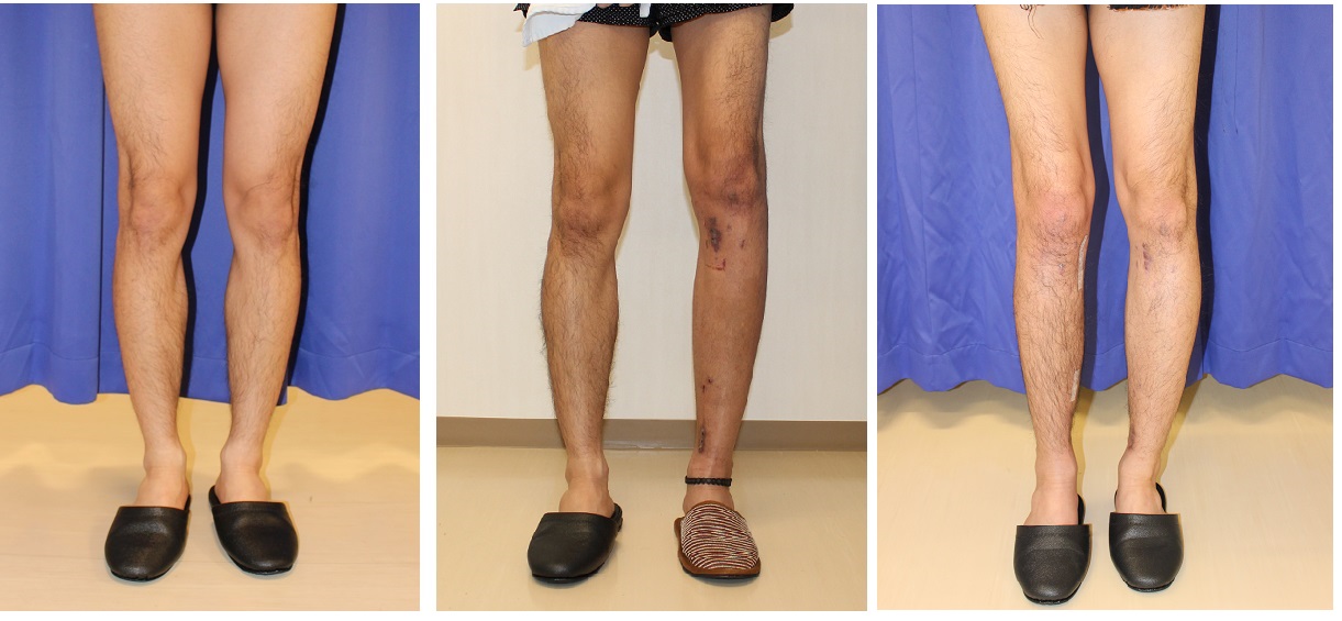 脚延長術　（ディバスティアーニ変法）左脚器具除去後5か月、右脚器具除去後3週間　　　両脚５ｃｍ延長達成_d0092965_0374239.jpg