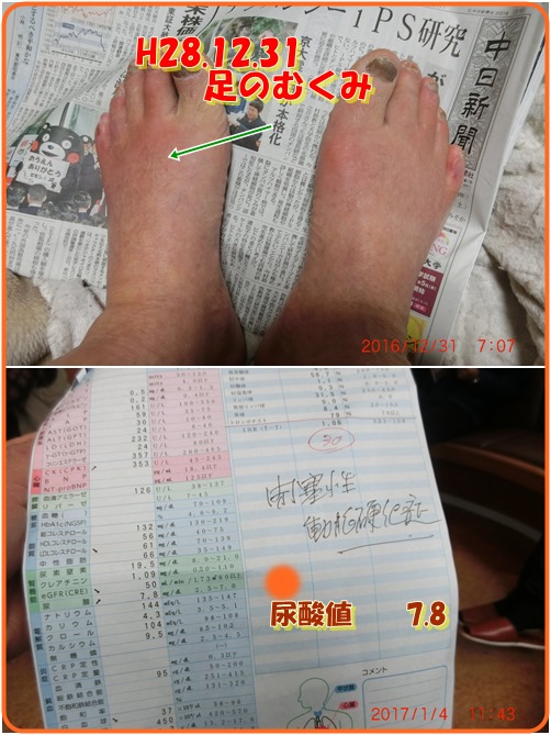 足の冷感は 下肢閉塞性動脈硬化症 小次郎じじ物語