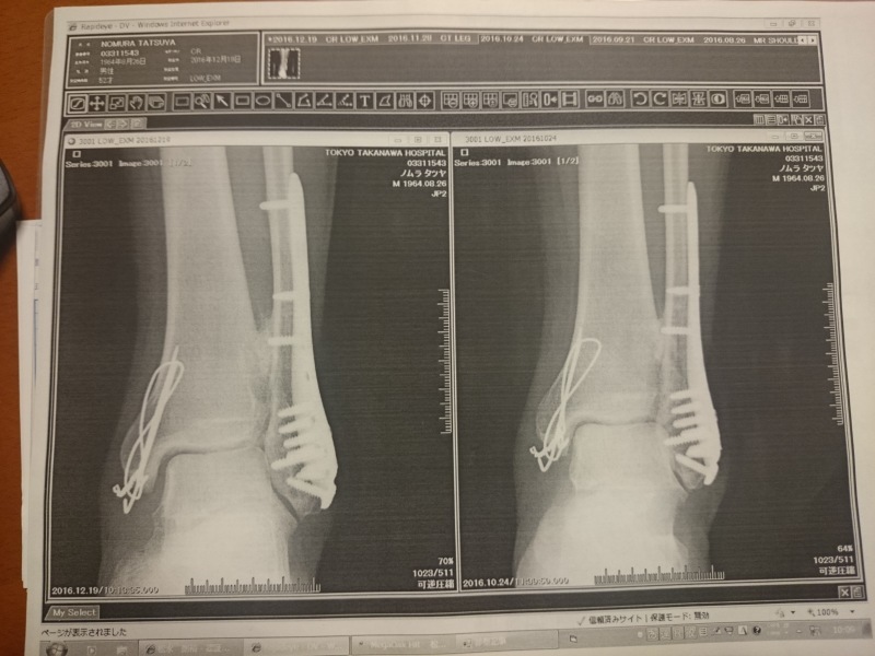 1月11日 手術後229日目 異所性骨化の状況です お休み日記 左足首脱臼骨折