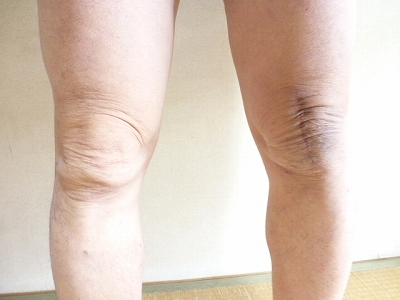 抜釘手術から1年 膝蓋骨骨折の記録 抜釘手術から1年 膝蓋骨骨折の記録