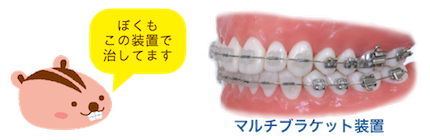 出っ歯（上顎前突）の治療開始時期に関して_e0025661_16322567.png