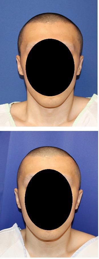 　側頭部頭蓋削り、他院後頭部アパタイト術後修正 術後6か月_d0092965_310330.jpg