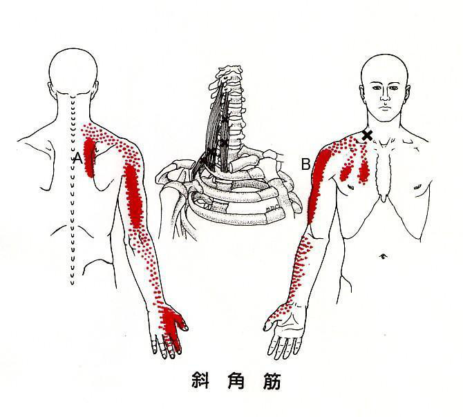 手 腕のしびれとだるさと痛み 胸郭出口症候群 ホロス加藤 札幌 カイロ トリガーポイント 手 腕のしびれとだるさと痛み 胸郭出口症候群 ホロス加藤 札幌 カイロ トリガーポイント