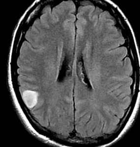 脳腫瘍が消えたno,２・・・手の振るえ_e0097212_11484731.jpg