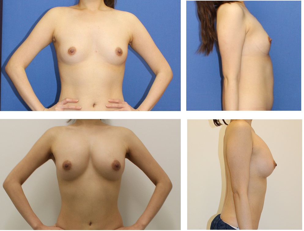 脂肪移植豊胸　術後約４年３か月　　（腹部より採取し両乳房へ脂肪移植）_d0092965_1501499.jpg