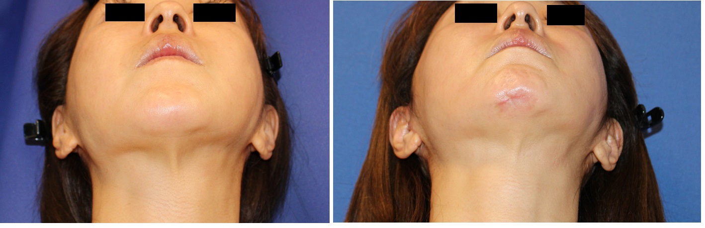 アキュリフト、ミニリフト、顎下ベイザー脂肪吸引、鼻アクアミド除去+鼻プロテーゼ留置等_d0092965_357162.jpg