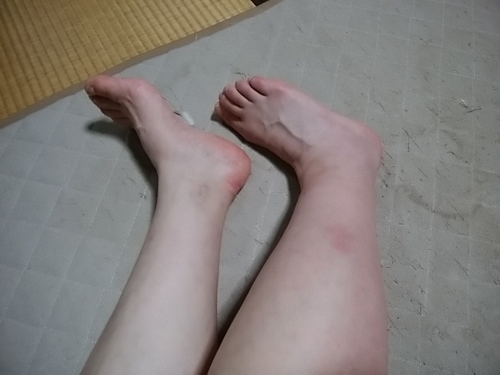 骨折日記7 骨折から28日目 Mepanna Works Banzai的な日々 骨折日記7 骨折から28日目 Mepanna Works Banzai的な日々