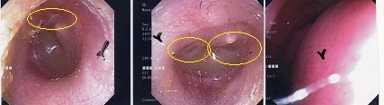 急性中耳炎・急性副鼻腔炎は、ウイルス感染症です。_a0082724_21425075.jpg