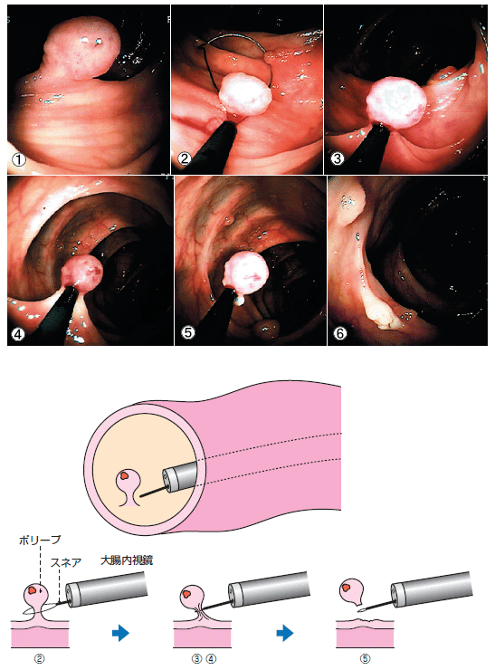 大腸ポリープのポリペクトミー_b0224178_13440601.gif