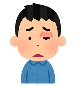 まぶたの腫れ(中平)_f0354314_14533045.png