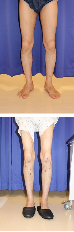 両脚　ＩＳＫＤ　（約１０日後差で手術）　術後約３か月_d0092965_1515315.jpg