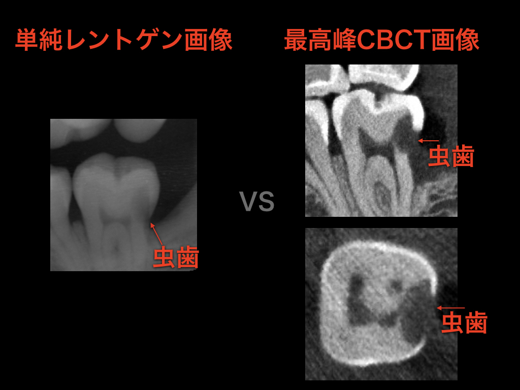 神経を抜かない　今現在最も難易度が高いCBCT併用顕微鏡虫歯治療_e0004468_06402632.jpeg