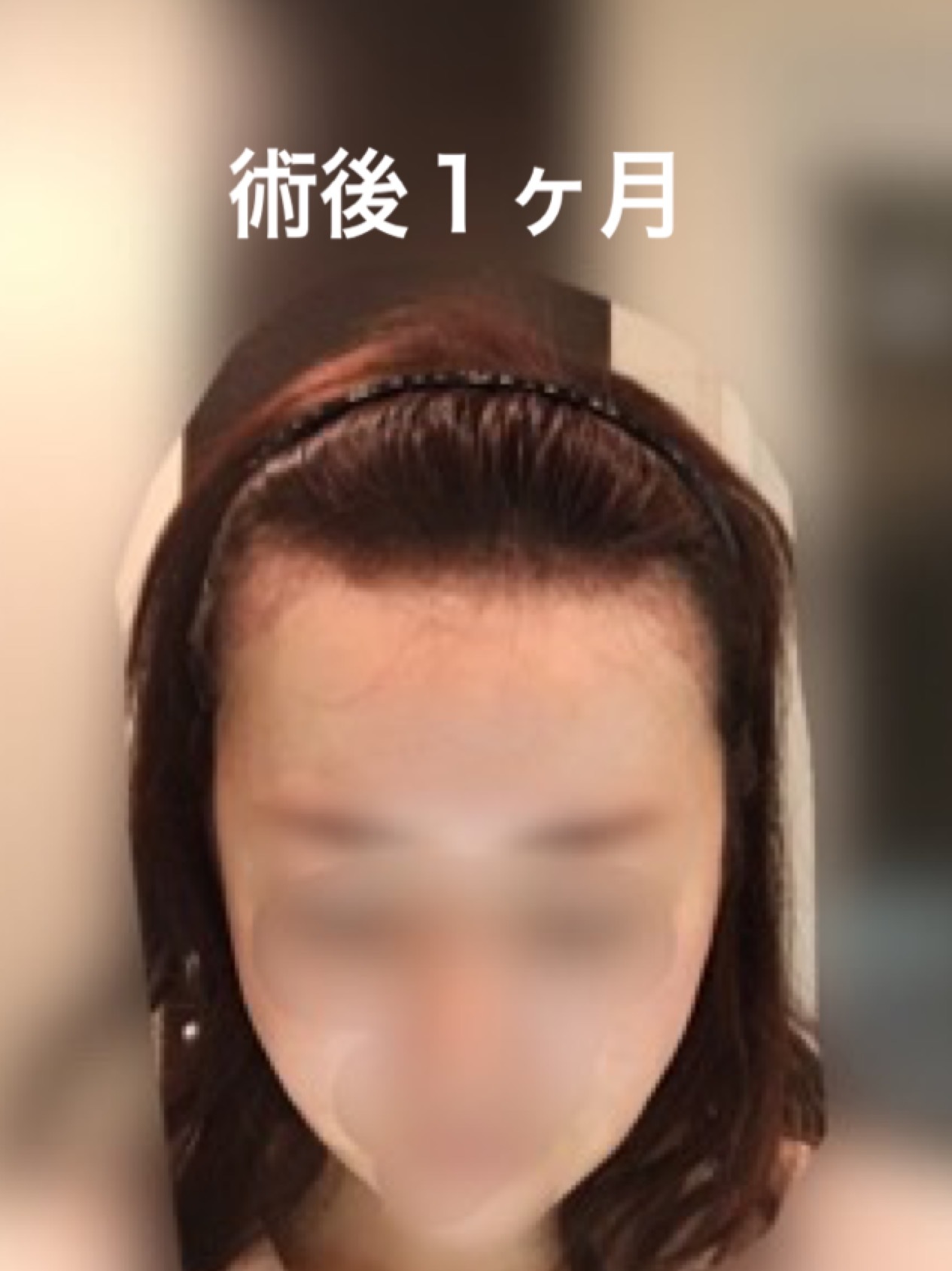 術後５ヶ月までのまとめ_d0367324_12192616.png