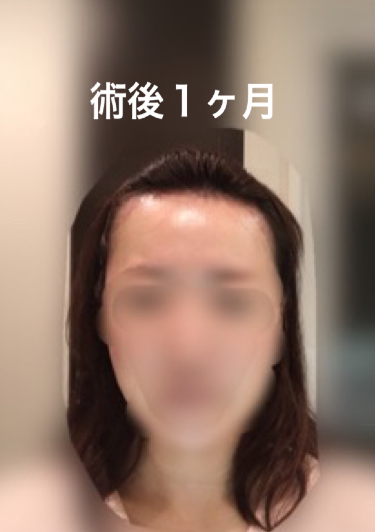 術後５ヶ月までのまとめ_d0367324_12202704.png