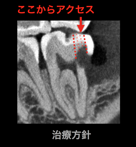 神経を抜かない　今現在最も難易度が高いCBCT併用顕微鏡虫歯治療_e0004468_10393854.png