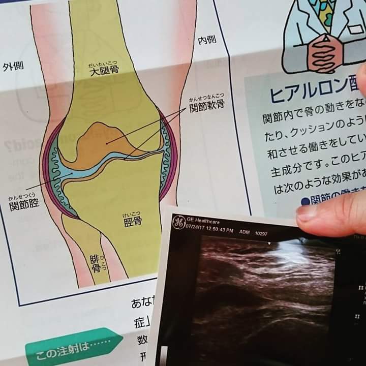 膝に水_f0172281_64423100.jpg