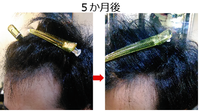 M字ハゲが改善した ちょっと からだに優しい美容院 Sweet Beach M字ハゲが改善した ちょっと からだに優しい美容院 Sweet Beach