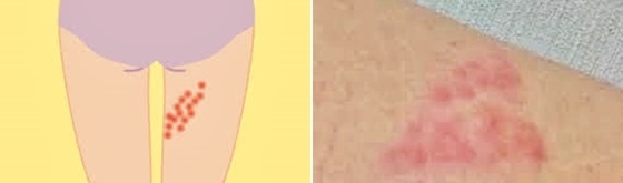 虫刺され じゃなかった 大変だ Mrs 和やか In 手帳 虫刺され じゃなかった 大変だ Mrs 和やか In 手帳