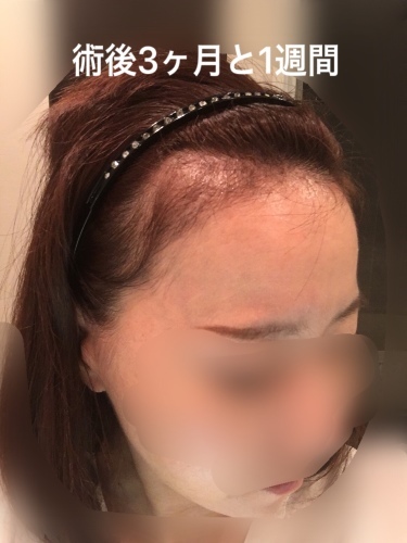 術後５ヶ月までのまとめ_d0367324_16105332.jpeg