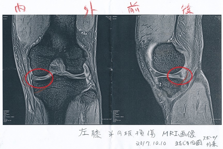 左膝半月板損傷と診断される 阿讃の山と谷