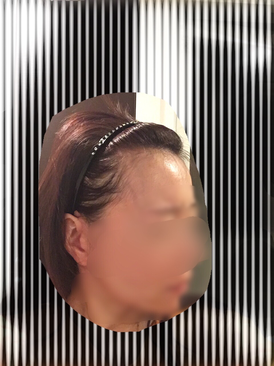 術後５ヶ月までのまとめ_d0367324_13512300.jpg