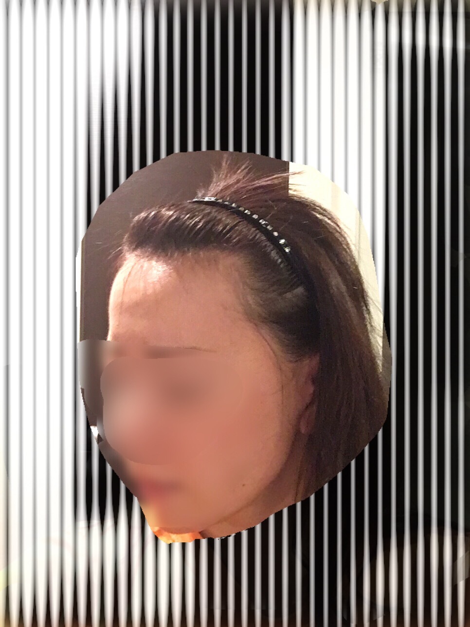 術後５ヶ月までのまとめ_d0367324_13512748.jpg