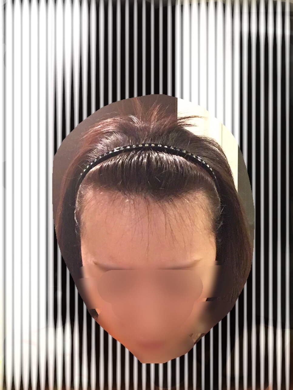 術後５ヶ月までのまとめ_d0367324_13513136.jpg