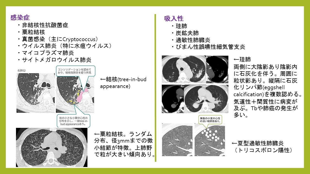 びまん性小粒状影の鑑別 永寿総合病院呼吸器ブログ