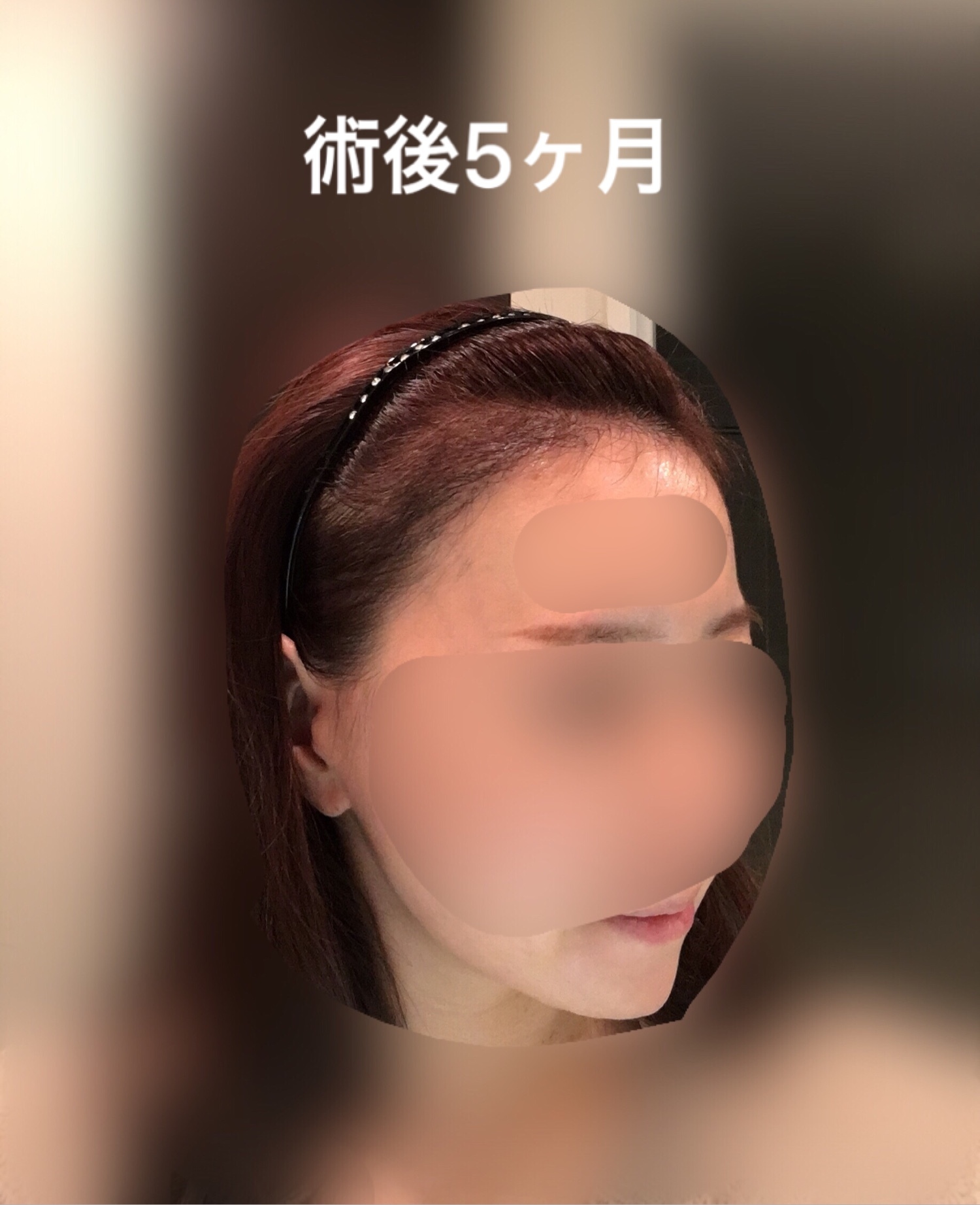 術後５ヶ月までのまとめ_d0367324_13195611.jpeg