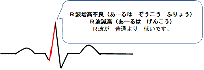 R 波 増 高 不良 と は