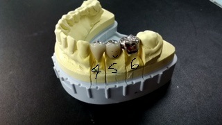 保険でブリッジの支台になる歯を白くできる件（条件付き）_b0191221_12044681.jpg