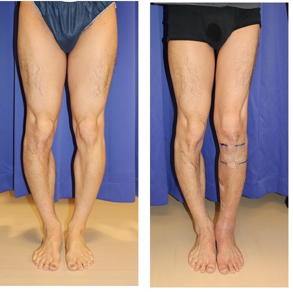 左下腿　脚延長　　precice（プリサイス） 　術後約７週間_d0092965_02560853.jpg