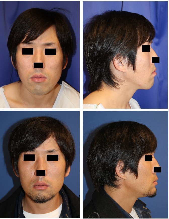 あご先中抜き骨切術 術後約半年再診時_d0092965_02370752.jpg