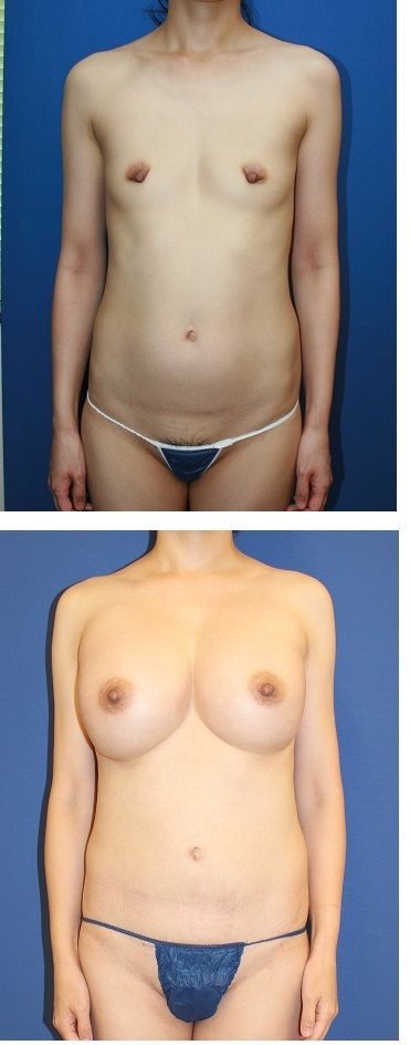 脂肪移植豊胸術後約７年再診時　（一年に３回の脂肪移植を２クール　お受けになられた患者さん）_d0092965_03021557.jpg