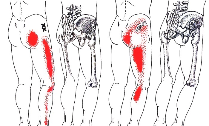 腰椎すべり症で右腰下肢痛に悩まされている女性（巨刺法の応用例）_c0113928_17033911.jpg