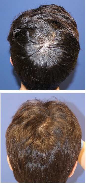 頭頂部のつむじをもっと毛を濃く　　：　ＨＡＲＧ　療法　　　（薬剤注射による育毛療法）_d0092965_01251603.jpg