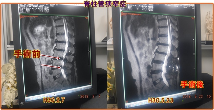 脊柱管狭窄症の2ｶ月後の定期健診 術後のリハビリ生活 小次郎じじ物語