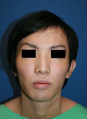頬骨V字骨切術，　ミントリフト，　法令線剥離術　　　術後約3か月_d0092965_06073957.jpg