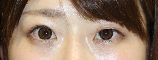 左眼　高周波二重形成術 術後１か月半 　　左眼　眼瞼挙筋短縮術_d0092965_07271898.jpg