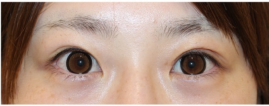 左眼　高周波二重形成術 術後１か月半 　　左眼　眼瞼挙筋短縮術_d0092965_07272913.jpg