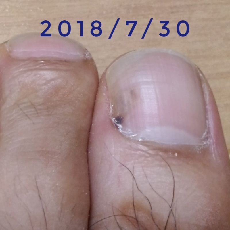 左足親指に黒いモノが 日々の出来事や感想などを記したもの