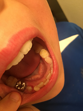 あれ 3年ぶり くらいに乳歯が抜けた 9歳でもtooth Fairyは来るのか くもりのち雨 ときど き晴れ Seattle Life 3 あれ 3年ぶり くらいに乳歯が抜けた 9歳でもtooth Fairyは来るのか くもりのち雨 ときど き晴れ Seattle Life 3