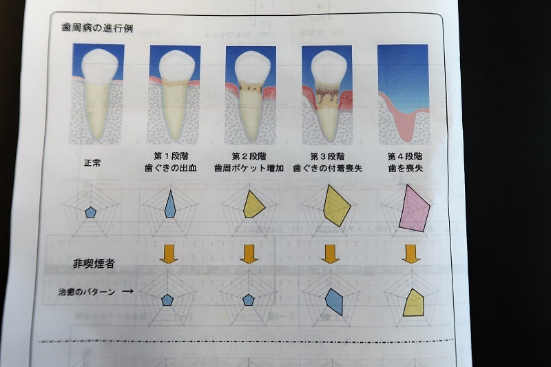 アルシオーネの継時劣化とトレッド剥離を考察_f0076731_12424249.jpg