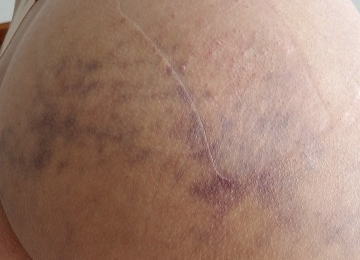 筋肉内出血 : 妖怪ブログ