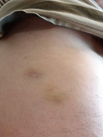 筋肉内出血 : 妖怪ブログ