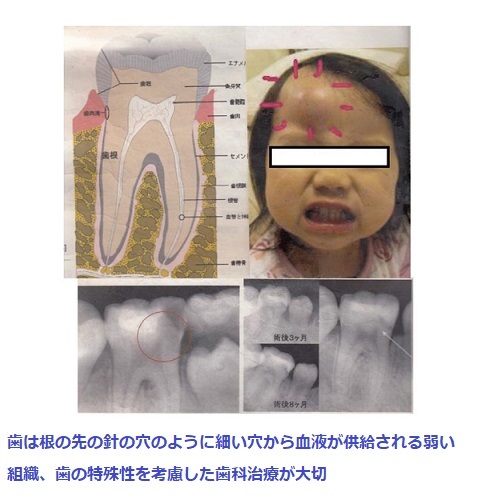 歯の特殊性を考慮した治療が大切_d0338857_04571154.jpg