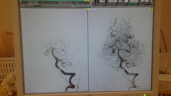 奇跡の生還ー脳梗塞・脳動脈狭窄ー6_c0229433_11031512.jpg
