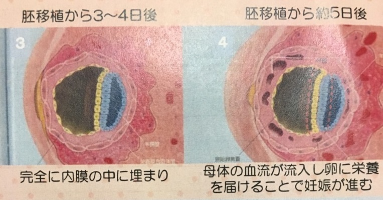 移植1 5日目の胚 40歳体外 育休 復職 同居できるかな日記